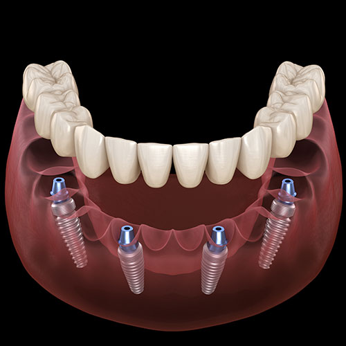 all on four dental implants in Mississauga