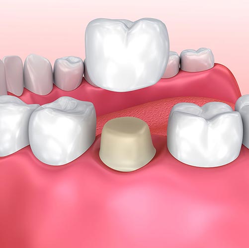 dental crowns in Mississauga provider