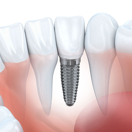 Mississauga Periodondist support dental implants procedure
