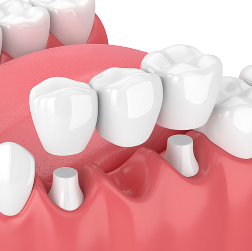 Check if you are a candidate for dental bridges in Mississauga