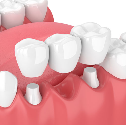 dental bridges in Mississauga